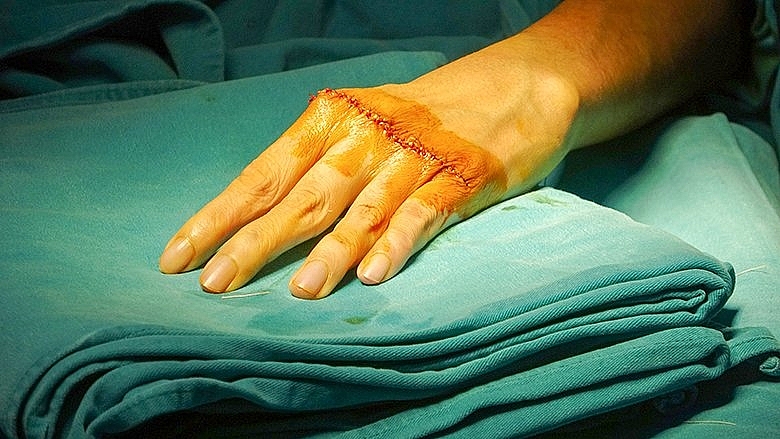 Bệnh viện Tâm Anh “hồi sinh” cho đôi bàn tay bị biến dạng, không co duỗi được suốt 20 năm