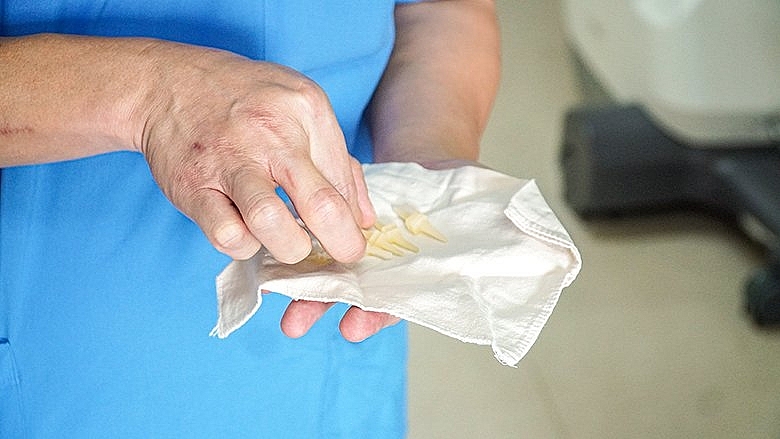 Bệnh viện Tâm Anh “hồi sinh” cho đôi bàn tay bị biến dạng, không co duỗi được suốt 20 năm